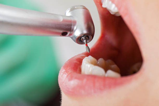 Best Emergency Wisdom Teeth Removal in Zephyrhills, FL